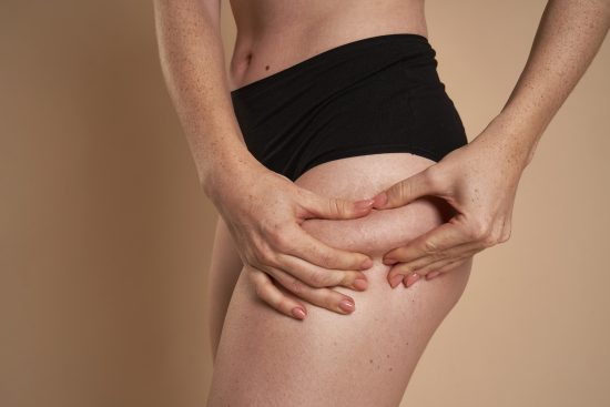 celulitis, piernas, salud, eliminacion, tratamiento