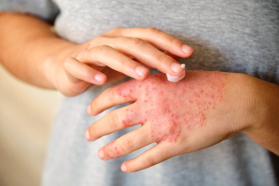 dermatitis, contacto, piel, picazon, cremas, humectantes