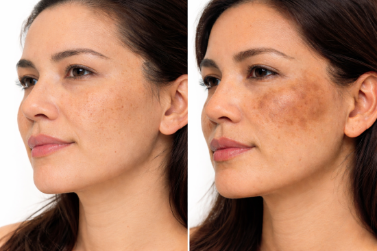 melasma, piel, problema, manchas, hiperpigmentacion, Melasma or Hyperpigmentation
