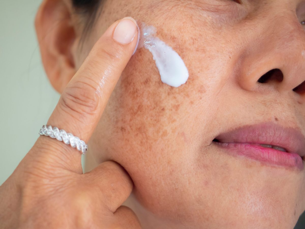 piel, melasma, hiperpigmentacion, manchas, oscuras